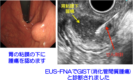 胃粘膜下腫瘍に対する・超音波内視鏡ガイド下せん刺(EUS-FNA）