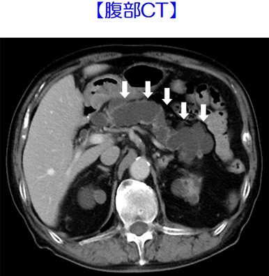 主膵管型膵管内乳頭粘液性腫瘍