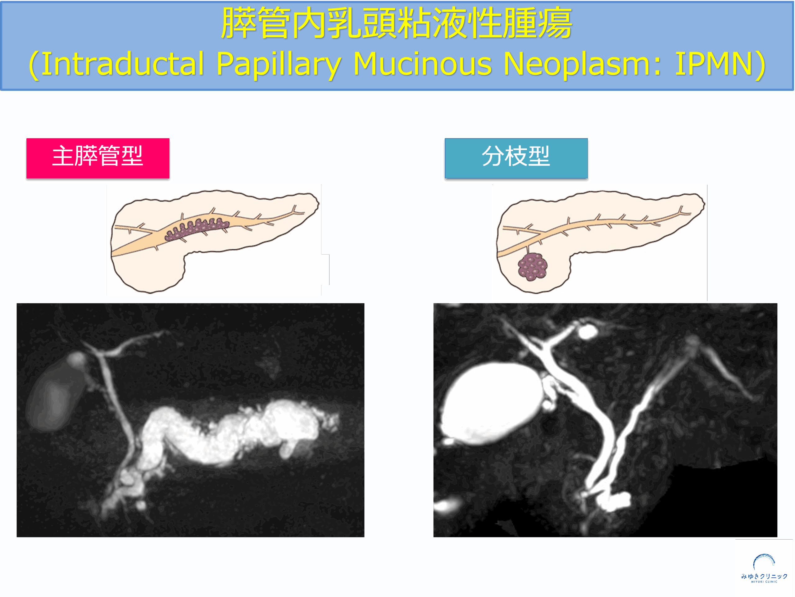 IPMN（膵管内乳頭粘液性腫瘍）の主膵管型と分枝型の違いとMRI画像所見