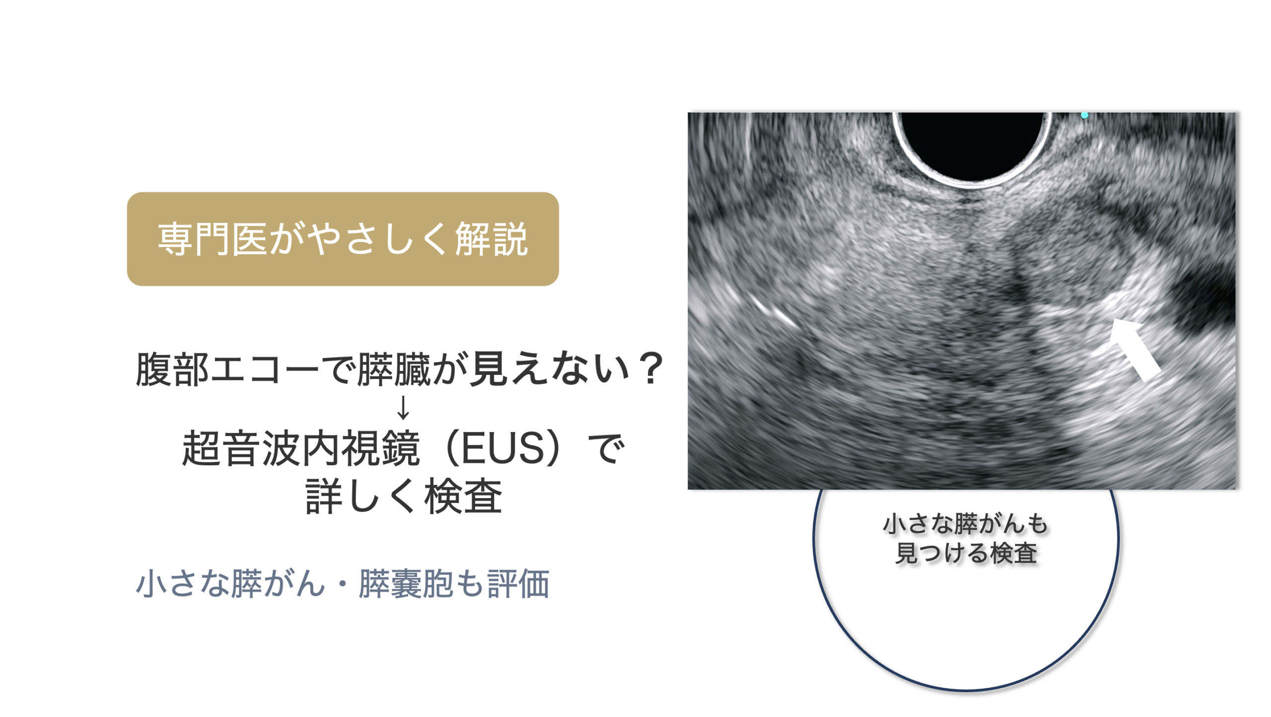 今月の1例：スキルス胃がん