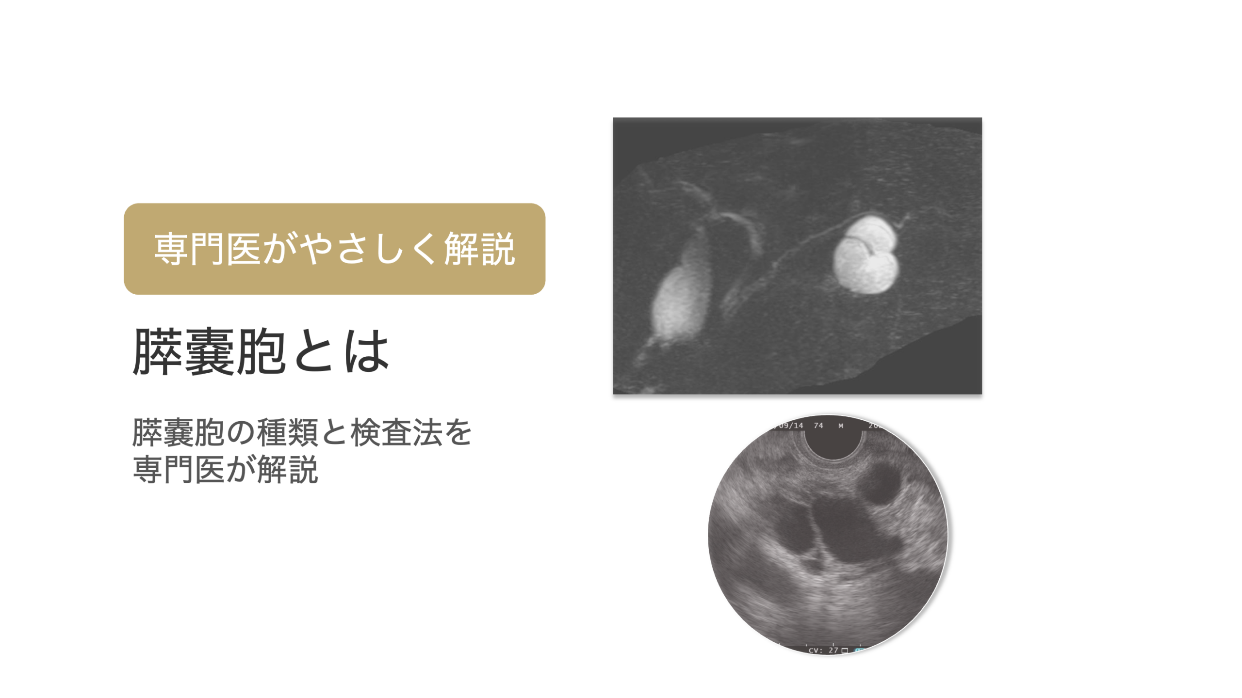 膵嚢胞（すいのうほう）とは？