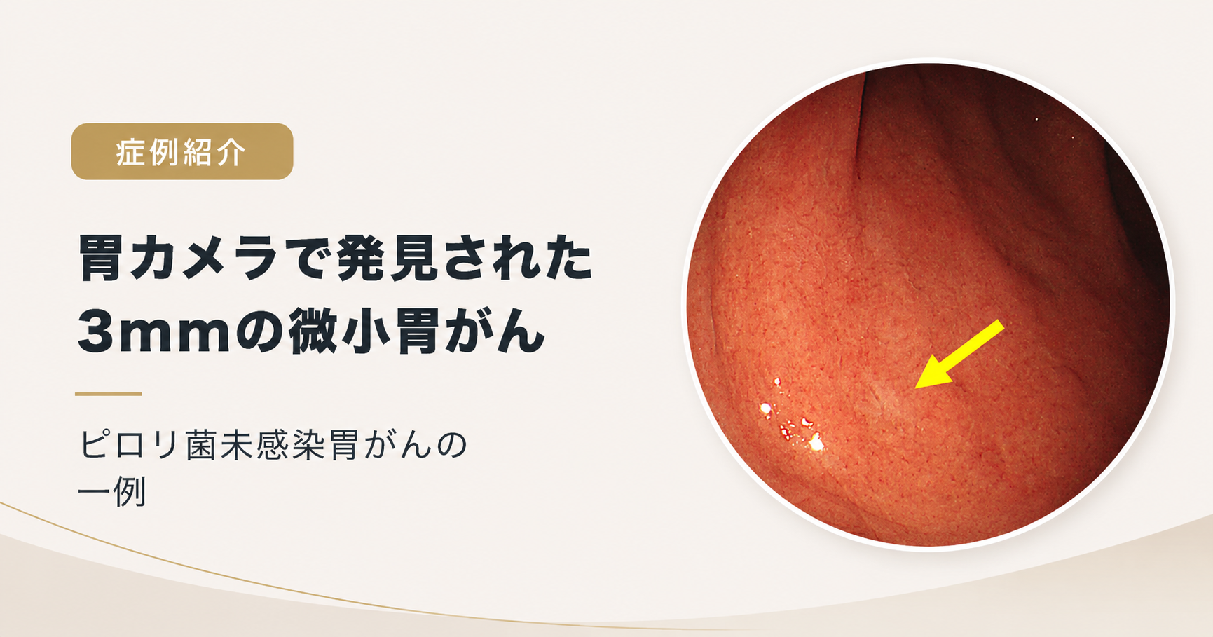 【症例】3mmの微小胃がんを胃カメラで発見|ピロリ菌未感染胃がん