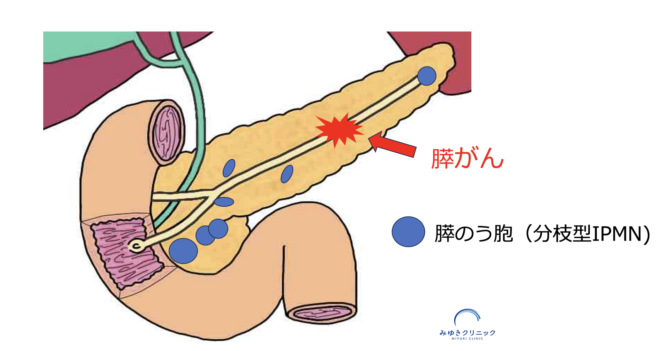 分枝型IPMNに併存した膵がんの位置関係を示したシェーマ