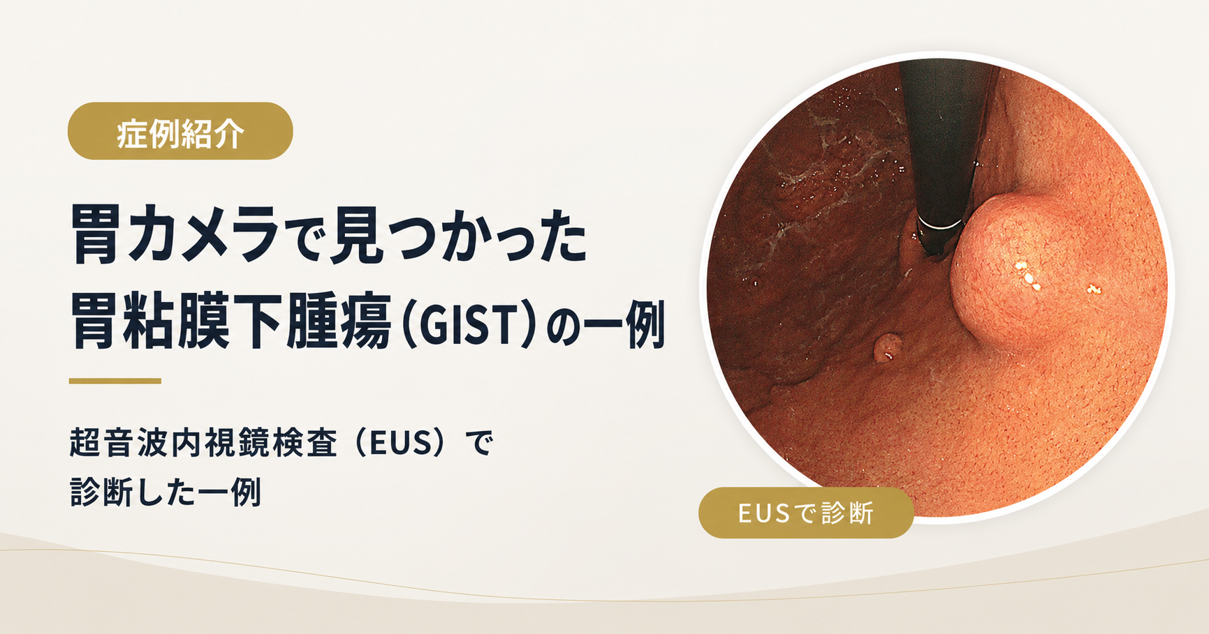 胃カメラで見つかった胃粘膜下腫瘍（胃GIST）の一例｜EUSによる精密