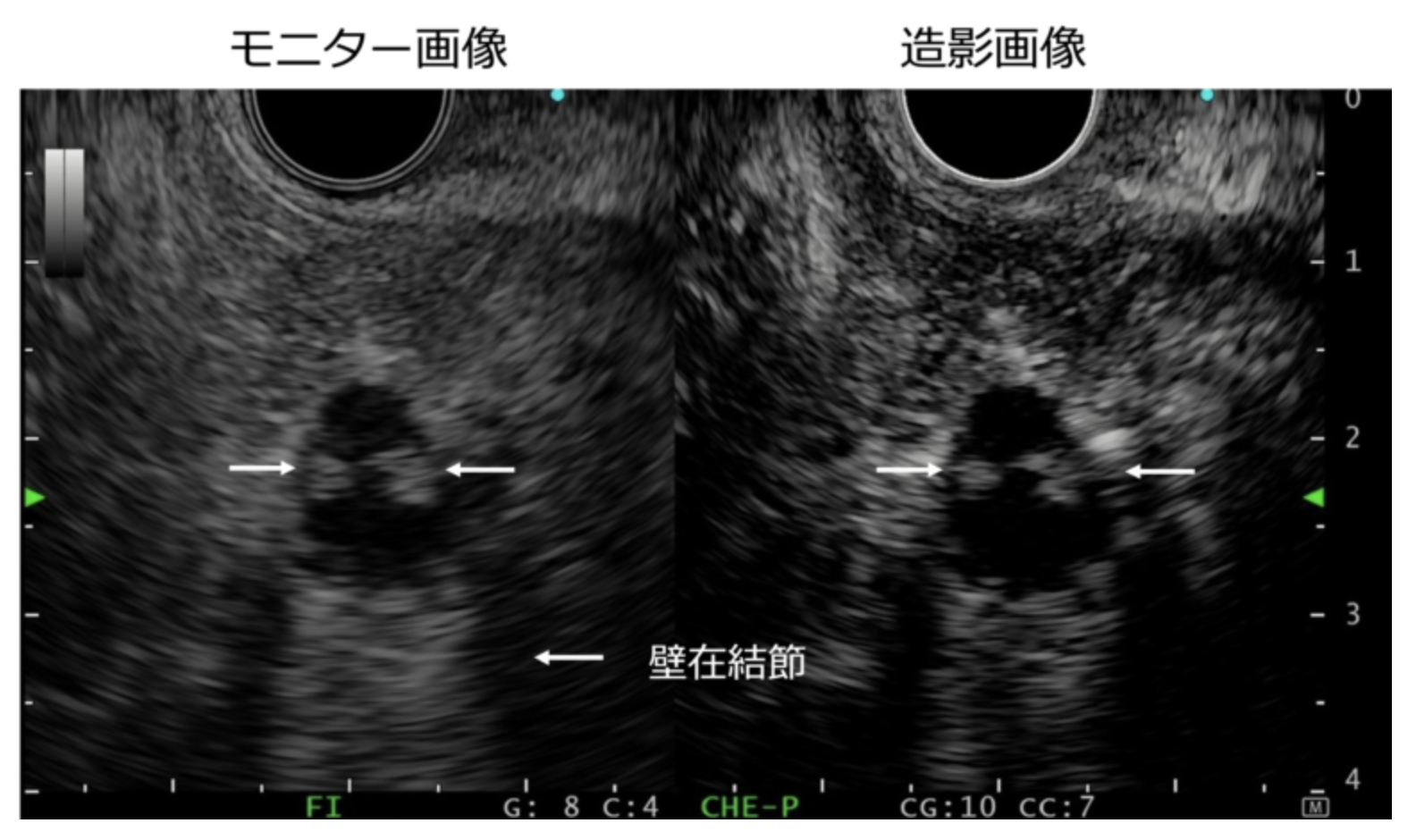 造影超音波内視鏡で壁在結節の血流を評価している画像