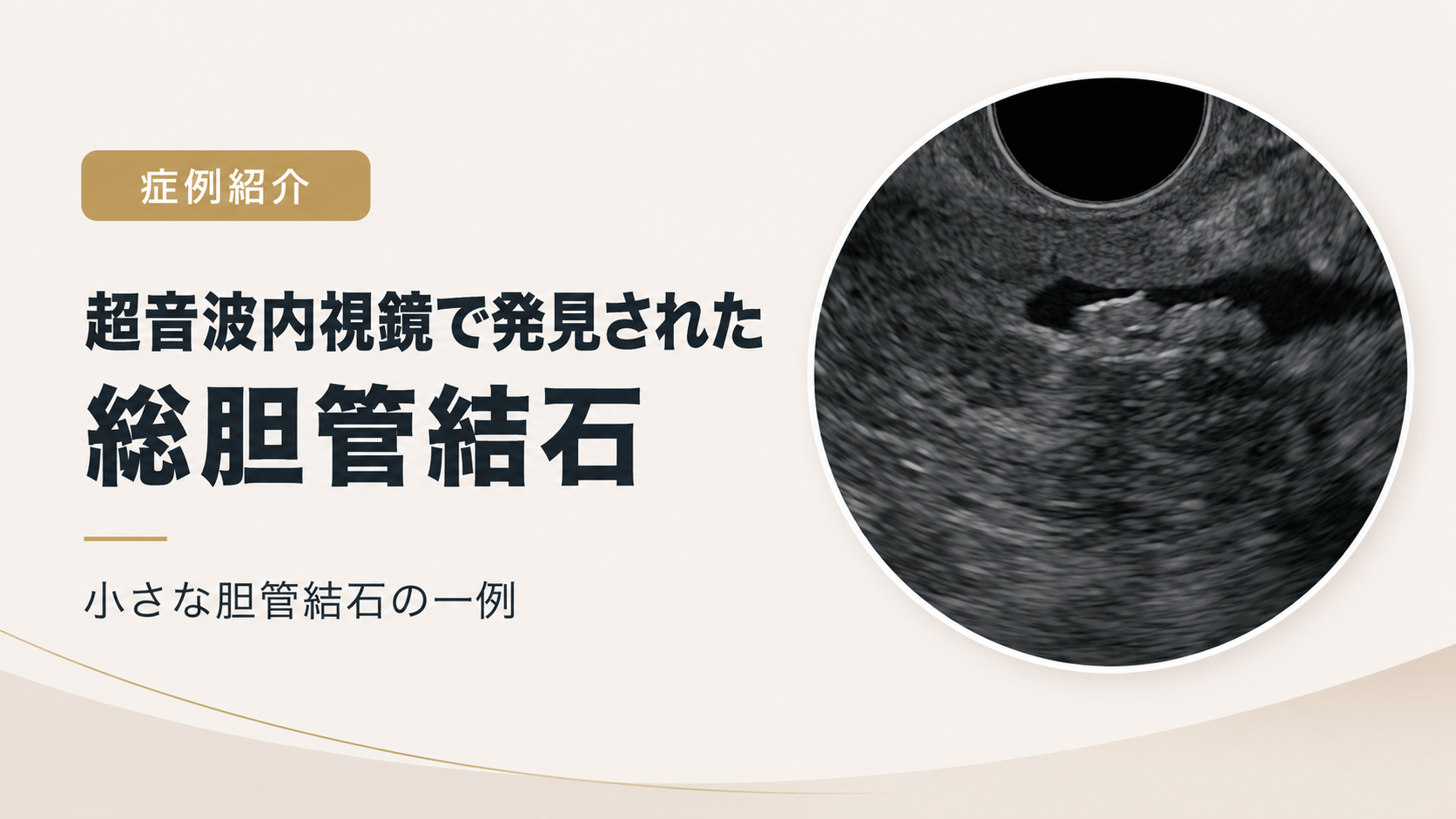 【症例】総胆管結石とは?胆のう結石との違い・症状・治療・受診目安を症例で解説
