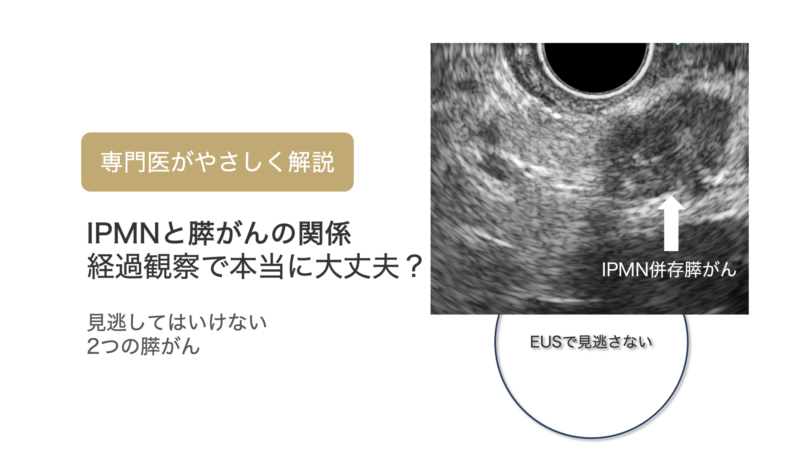 膵管内乳頭粘液性腫瘍(IPMN)と膵がんの関係とは?:IPMN由来膵がんとIPMN併存膵がんについて解説