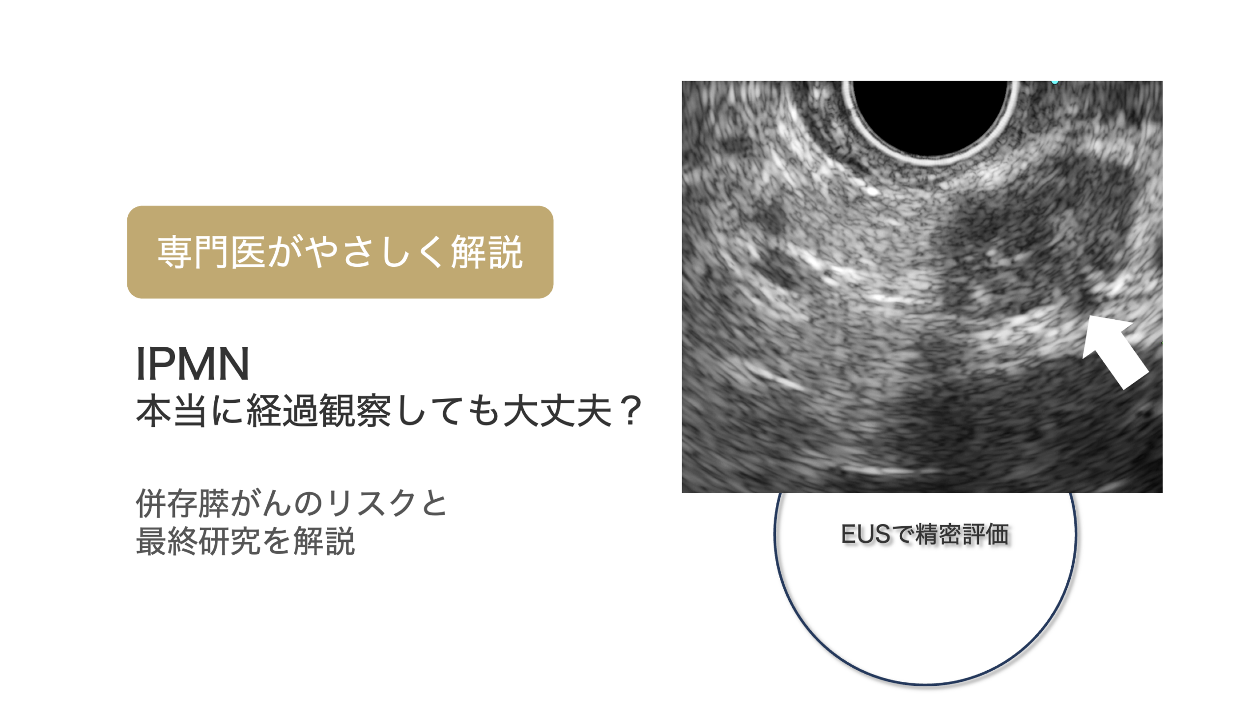 論文紹介：日本における分枝型膵管内乳頭粘液性腫瘍の悪性化の実際：多施設共同研究