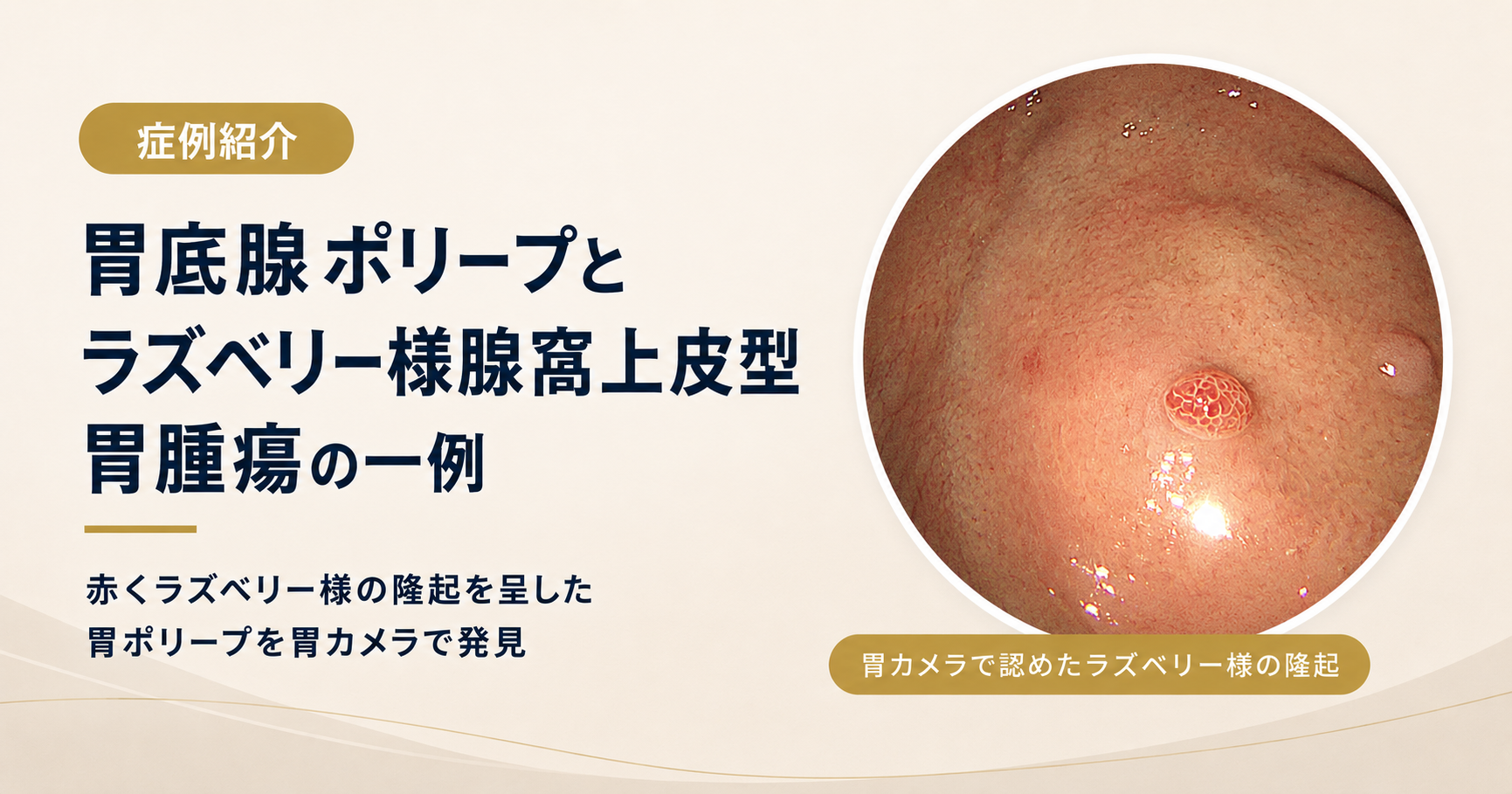 【症例】胃底腺ポリープとラズベリー様腺窩上皮型胃腫瘍|胃カメラで見分けたい胃ポリープを専門医が解説