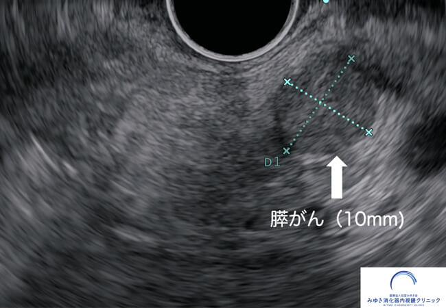 胆のう・胆管・膵臓の画像検査