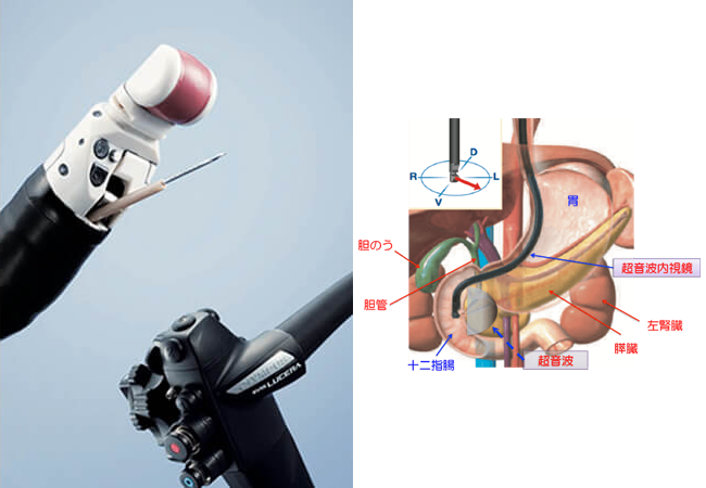 超音波内視鏡検査(EUS)とは？