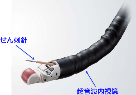 超音波内視鏡下せん針吸引法（EUS-FNA）とは？