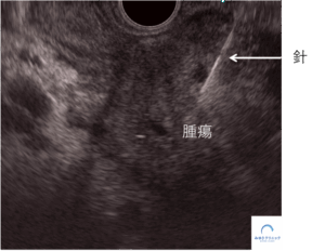 同一症例の膵頭部がんを示すEUS画像｜腫瘍と穿刺針（EUS-FNA）を描出