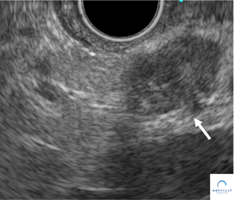 今月の1例：膵管内乳頭粘液性腫瘍（IPMN）併存膵がん（手術後5年再発なし！）
