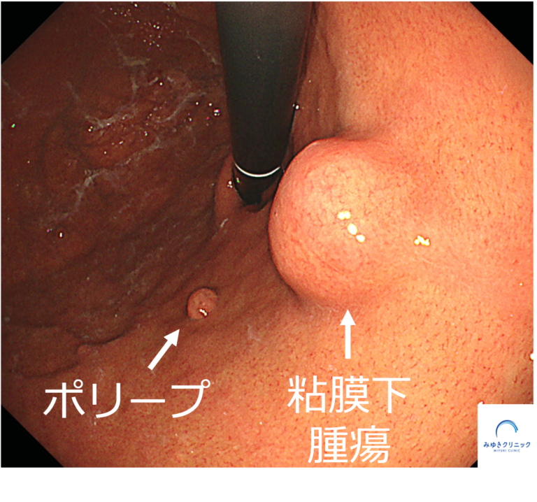 今月の1例：胃粘膜下腫瘍（GIST）