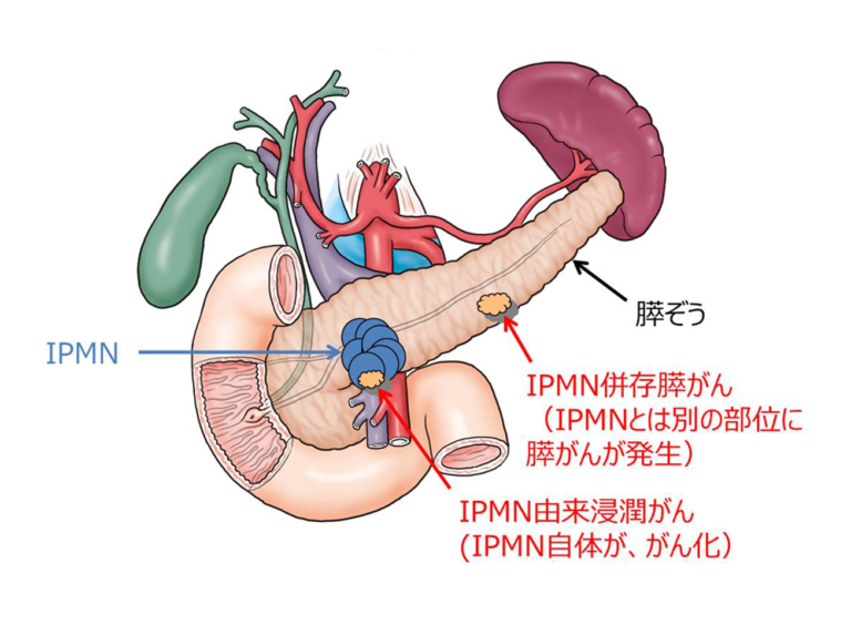 今月の1例：総胆管結石