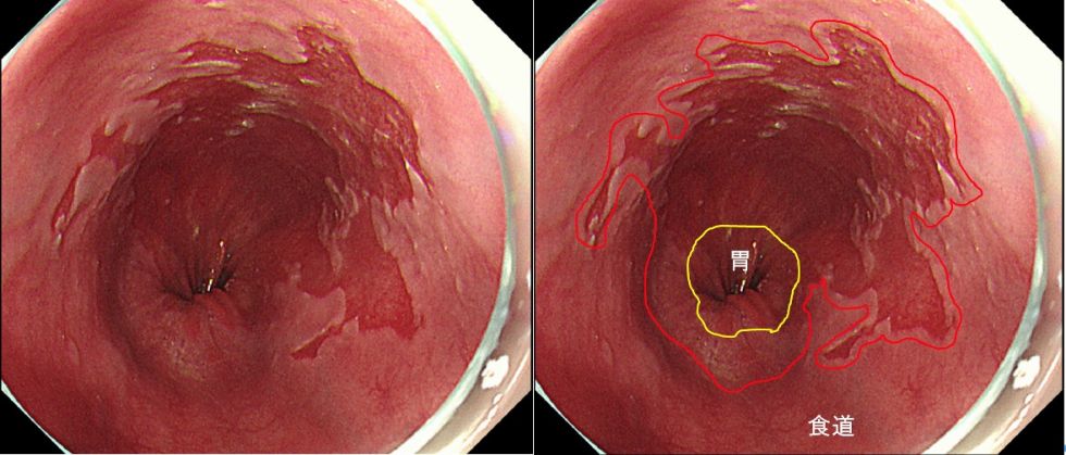 バレット食道（黄色線と赤線の間）（胃内視鏡検査）の写真