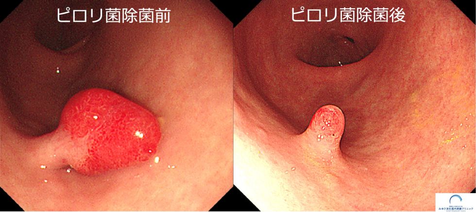 胃過形成ポリープ（胃内視鏡検査）の写真