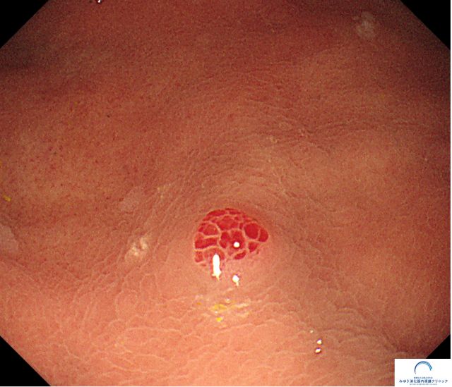 ラズベリー様腺窩上皮型胃腫瘍（胃内視鏡検査）の写真