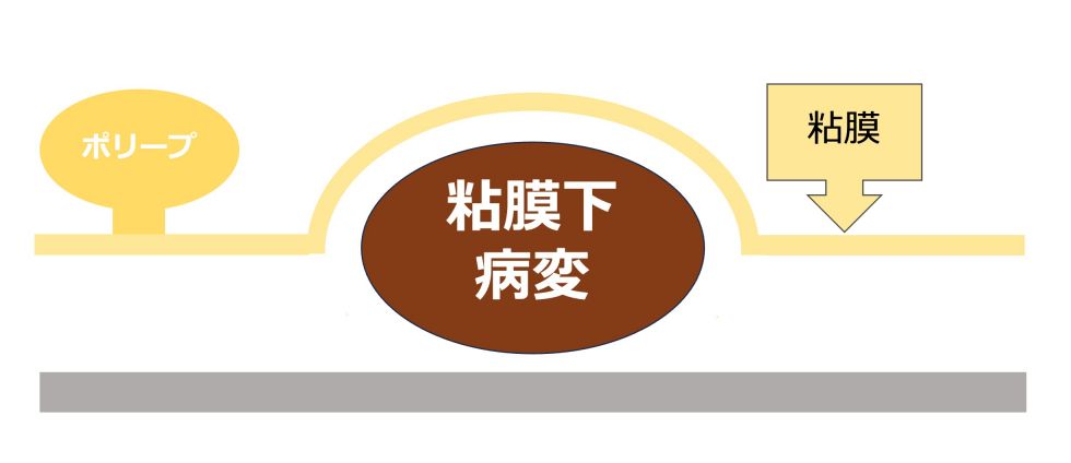 胃粘膜下病変（腫瘍）のイラスト図