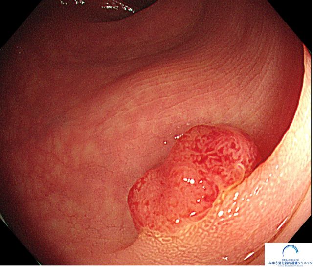 大腸ポリープ（大腸内視鏡検査）の写真