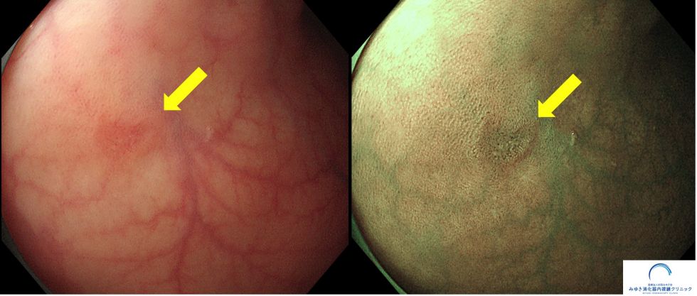 大腸ポリープ（5mm 高異型度腺腫）（大腸内視鏡検査）の写真