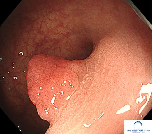 早期大腸がん（大腸内視鏡検査）の写真
