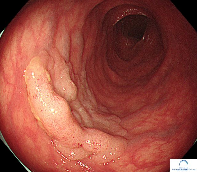 早期大腸がん（大腸内視鏡検査）の写真