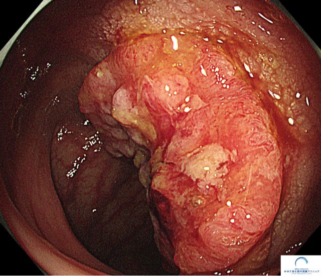 進行大腸がん（大腸内視鏡検査）の写真