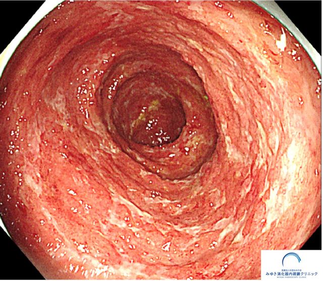 潰瘍性大腸炎（大腸内視鏡検査）の写真