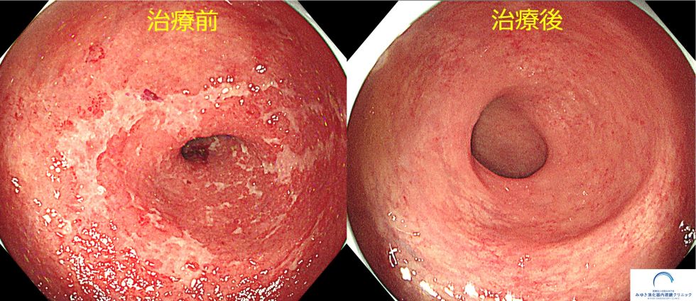潰瘍性大腸炎（治療前後）（大腸内視鏡検査）の写真