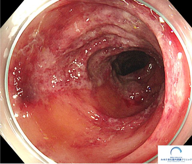 虚血性腸炎（大腸内視鏡検査）の写真