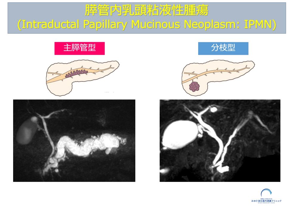 主膵管型IPMNと分枝型IPMNのイラストと図
