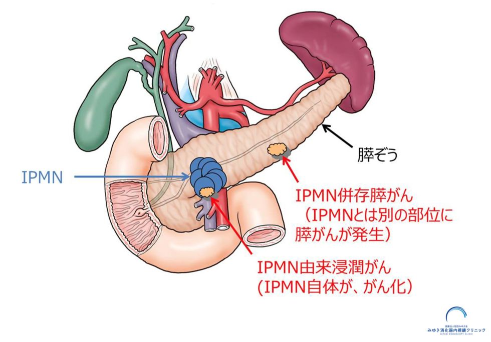 IPMN由来膵がんとIPMN併存膵がんの解説イラスト