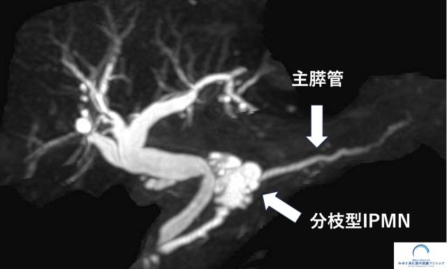 分枝型IPMNのMRI