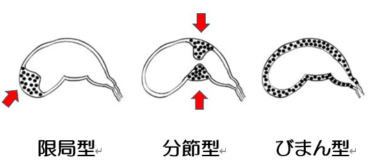 胆のう腺筋症の３タイプの解説イラスト