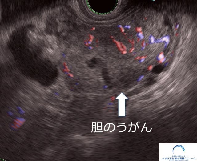 胆のうがん（超音波内視鏡検査）