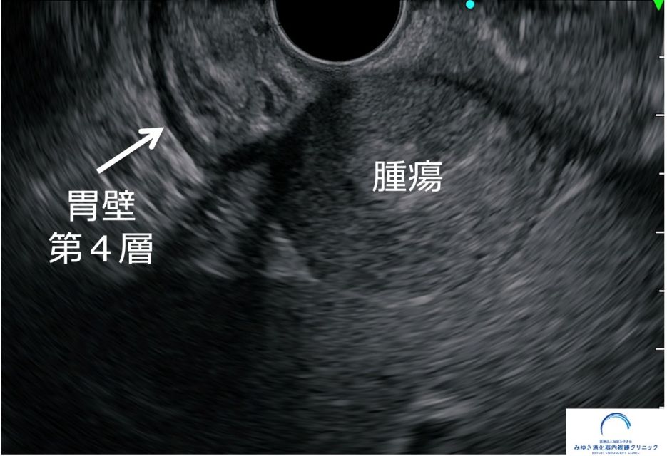 胃粘膜下腫瘍に対する超音波内視鏡下せん刺吸引法（EUS-FNA：上と同一症例）