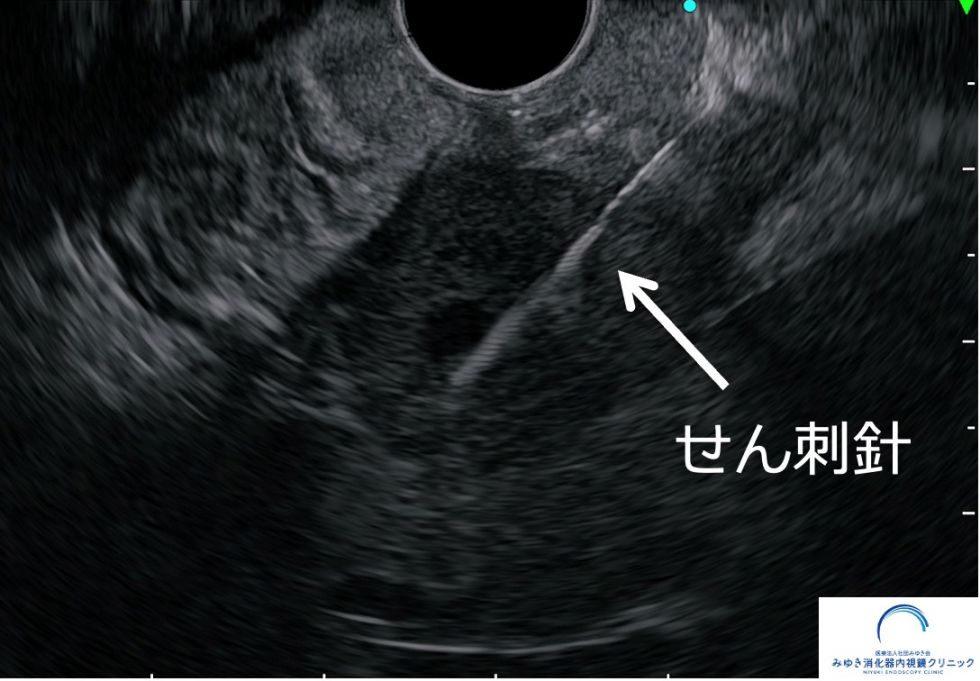 胃粘膜下腫瘍に対する超音波内視鏡下せん刺吸引法（EUS-FNA：上と同一症例）