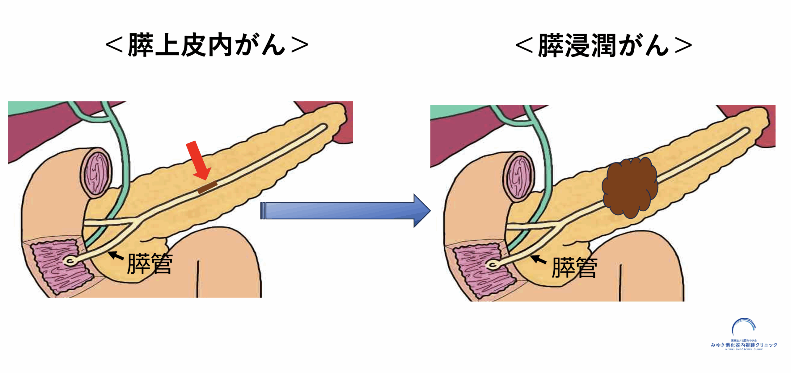 膵液細胞診とは？膵上皮内がんの早期発見に期待される検査法を解説