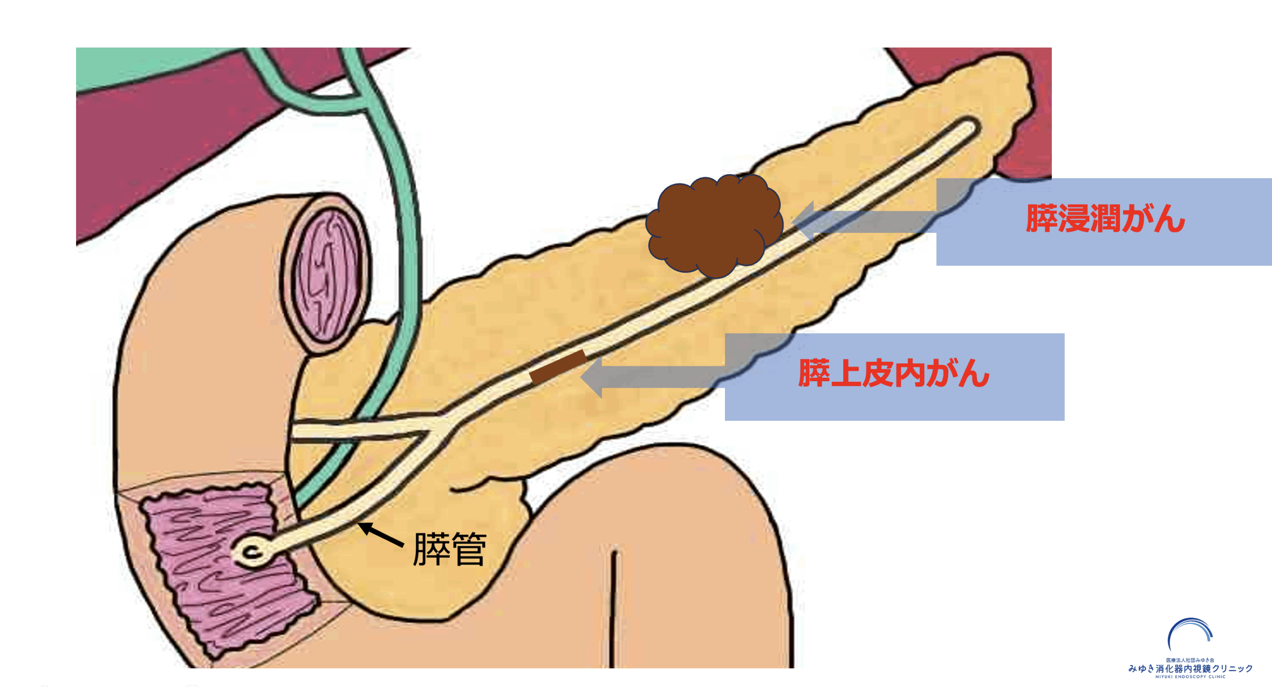 膵上皮内がんと浸潤性膵がんの違いを示した模式図