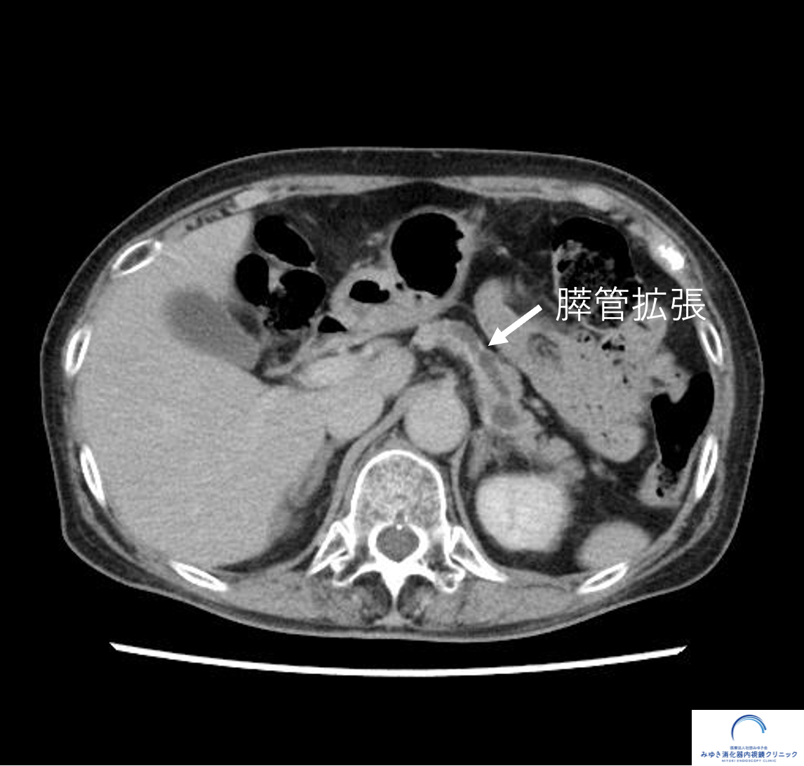 CTで認められた膵嚢胞と主膵管拡張および膵実質の萎縮