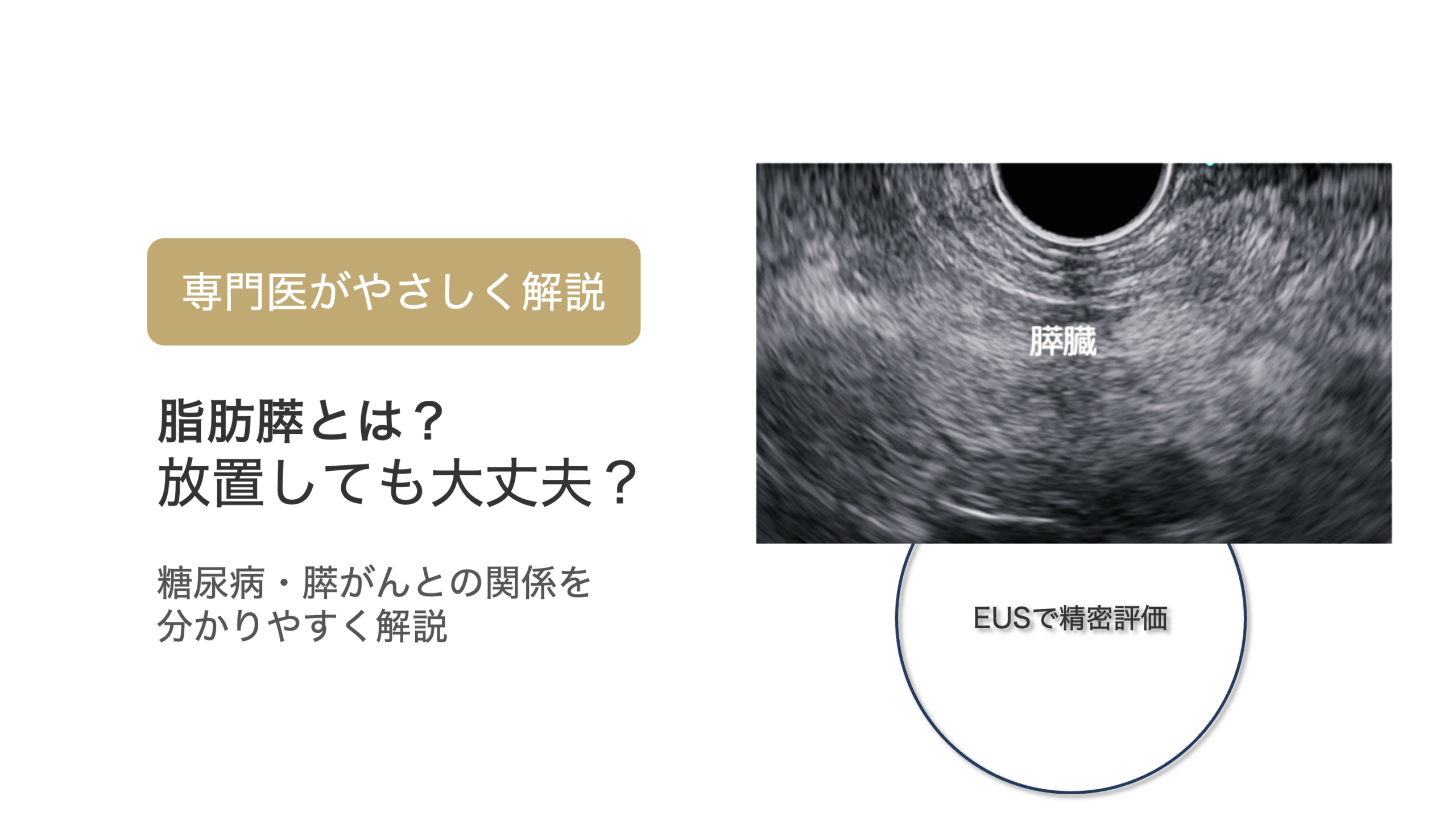脂肪膵とは?糖尿病と膵がんとの関係を分かりやすく解説