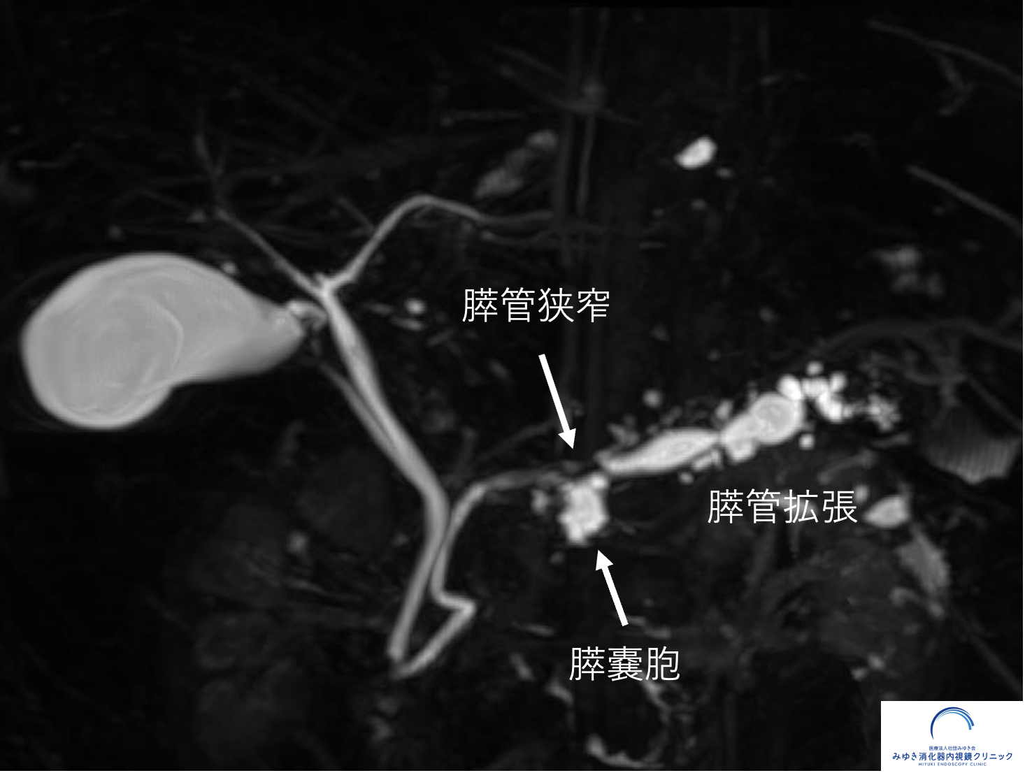 今月の1例：膵上皮内がん（ステージ0膵がん）の早期発見