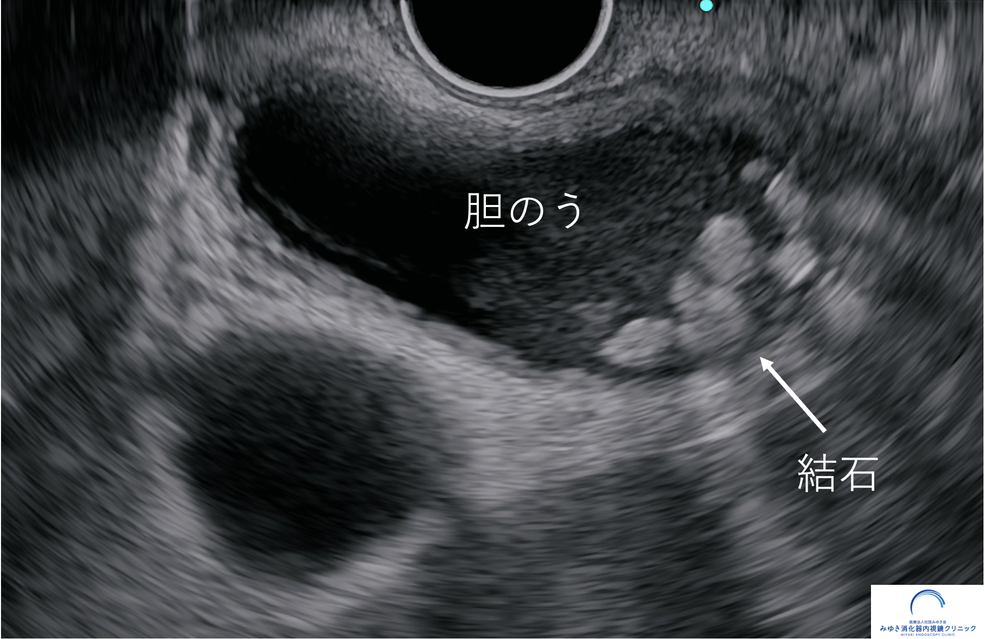 胆のう結石について解説する模式図