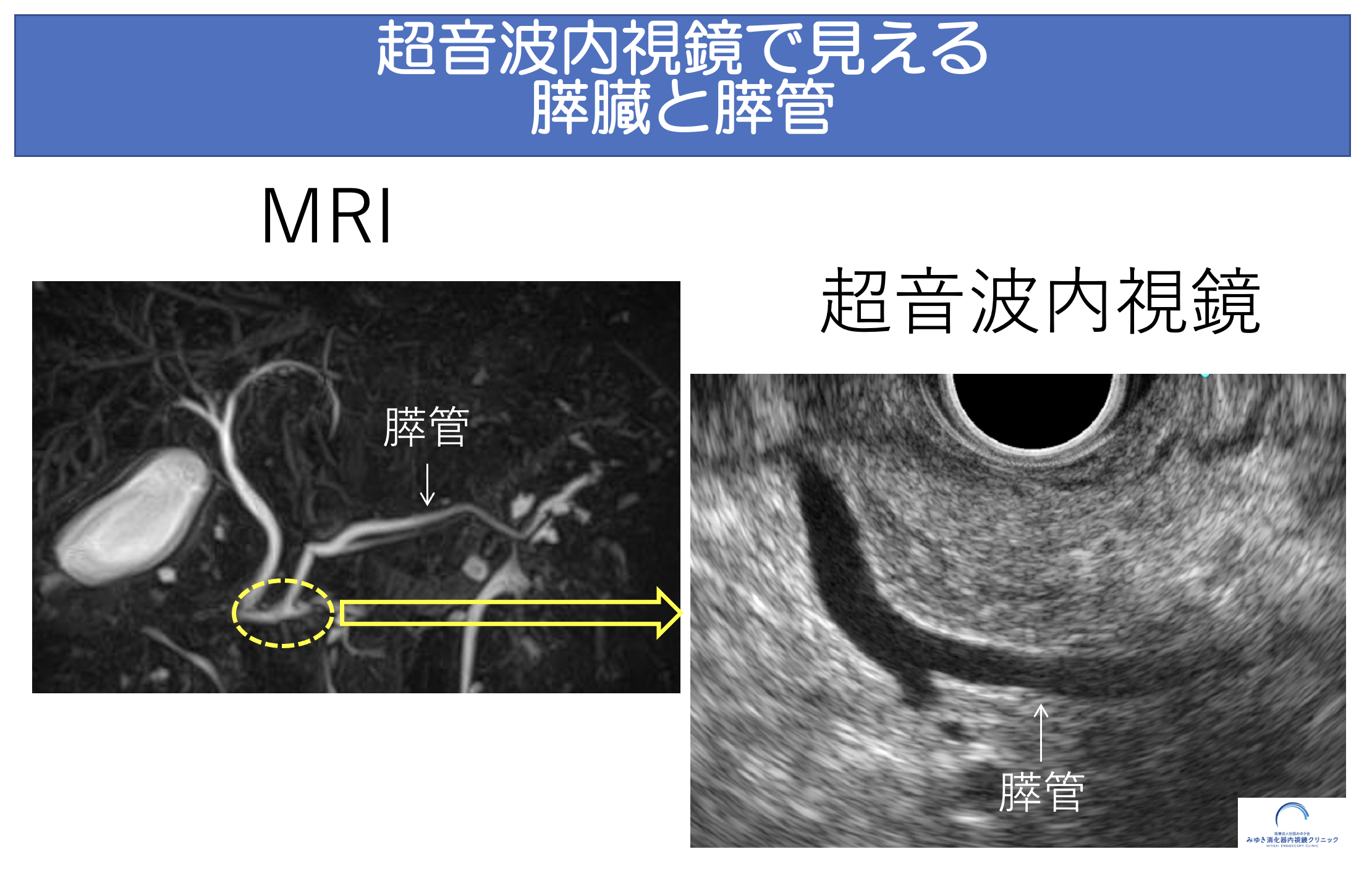 超音波内視鏡（EUS）とは？MRIやCTと何が違うの？