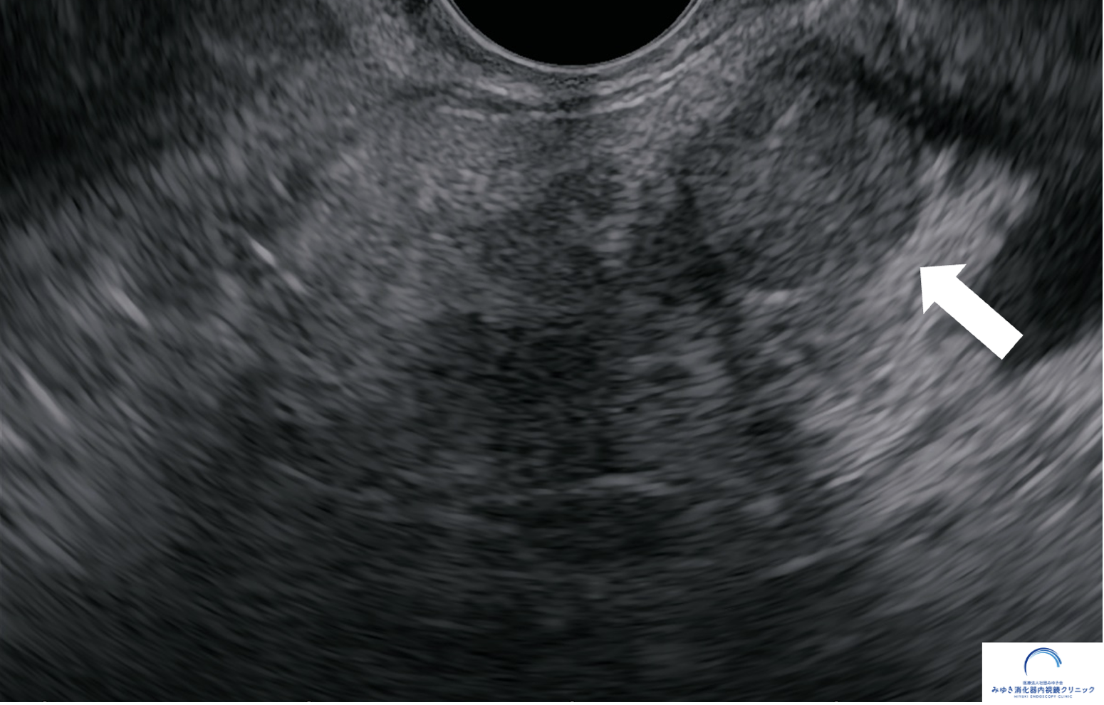 ステージ1膵がんを示した超音波内視鏡（EUS）画像 約10mmの膵腫瘍