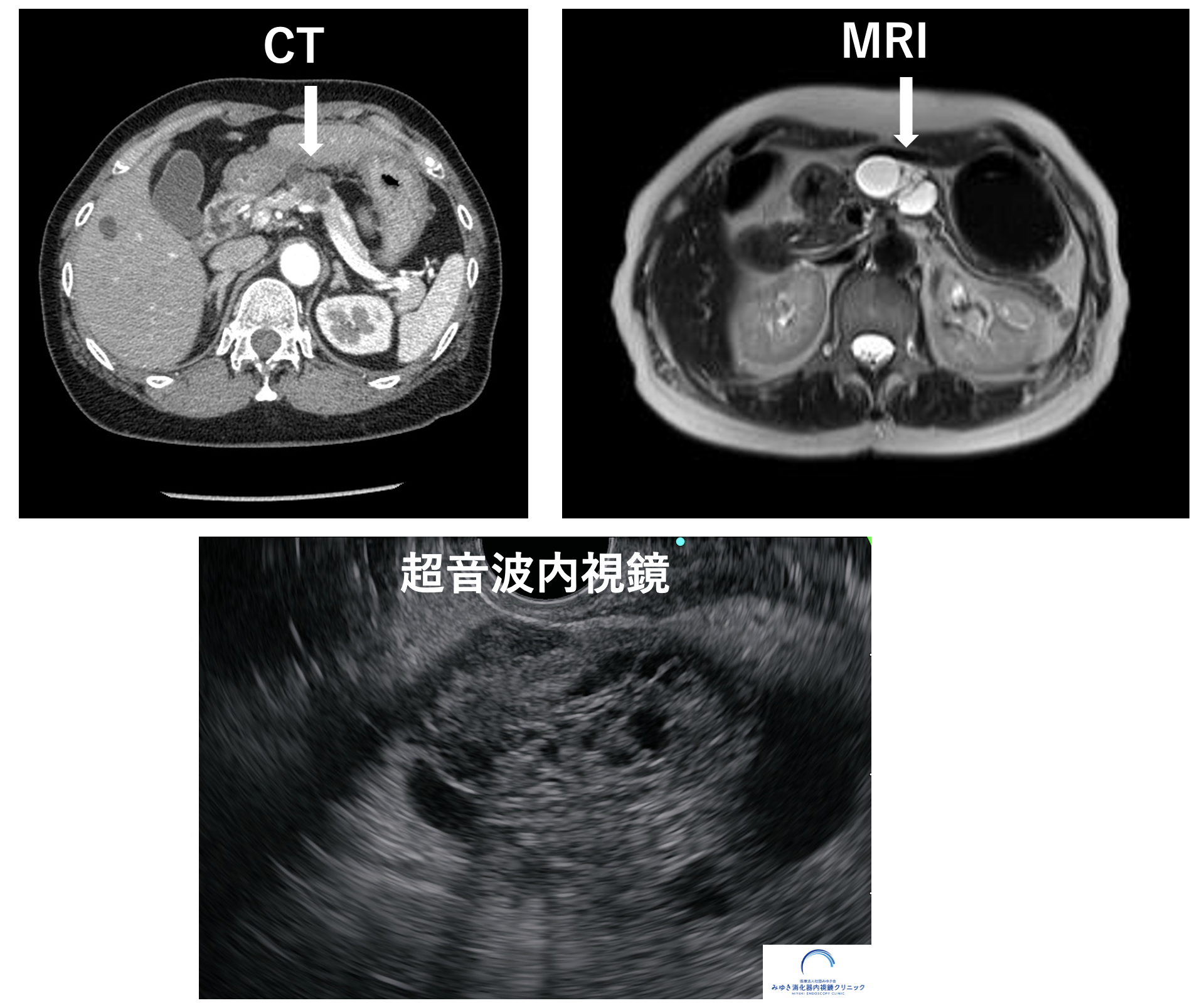 膵漿液性嚢胞腫瘍（SCN）の超音波内視鏡（EUS）画像