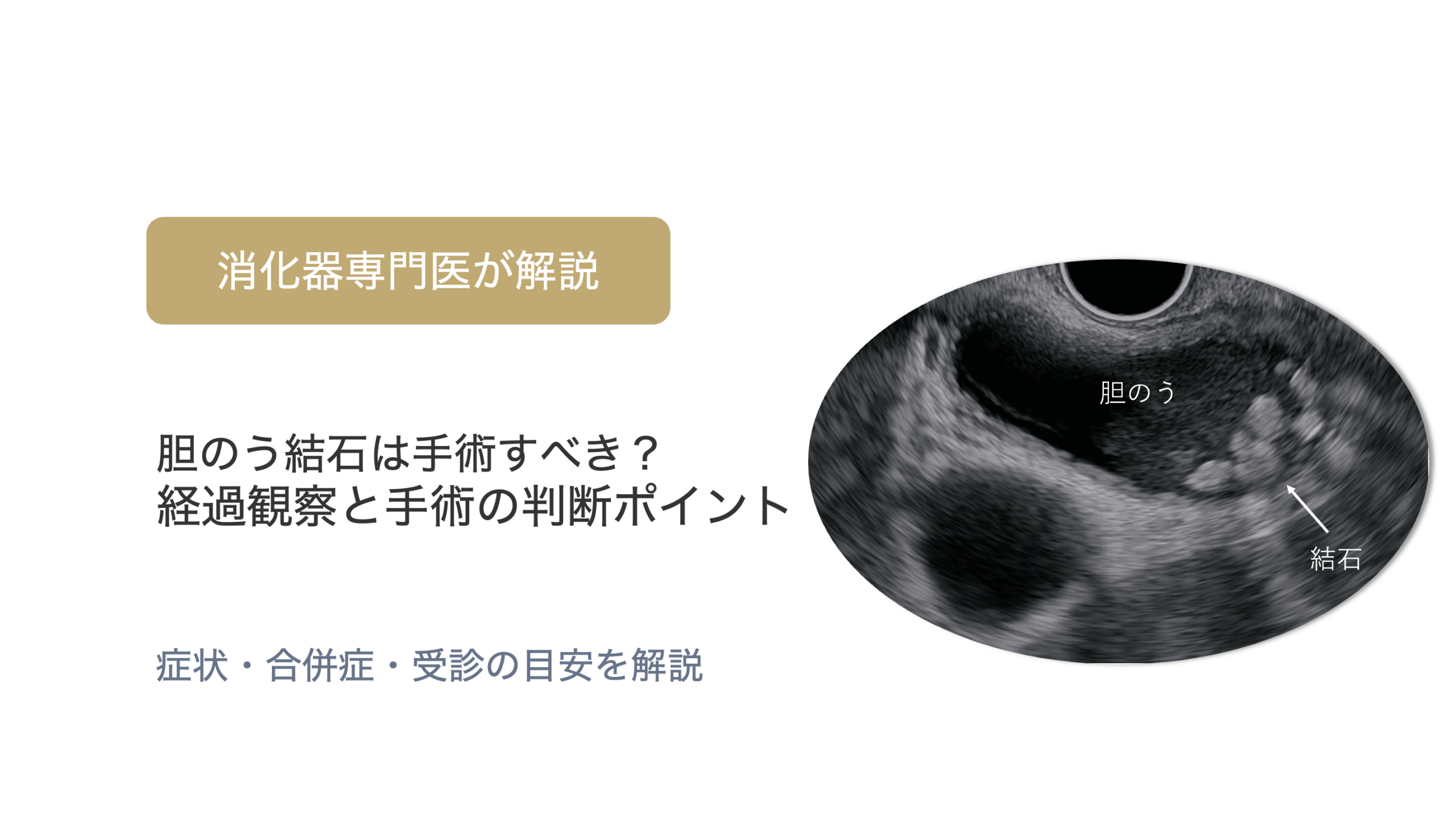 胆のう結石は手術すべき？