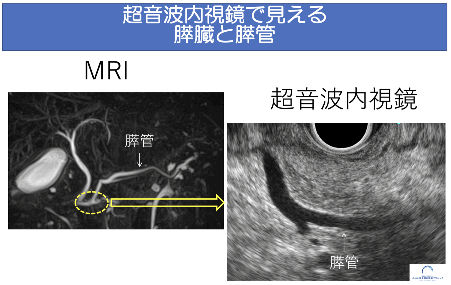MRIと超音波内視鏡（EUS）で見える膵臓・膵管の違いを示した比較図